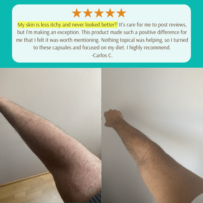 EczPro - Probiotics for Eczema, Natural Remedy, 13 Histamine-Safe Strains, Allergen-Free Formula