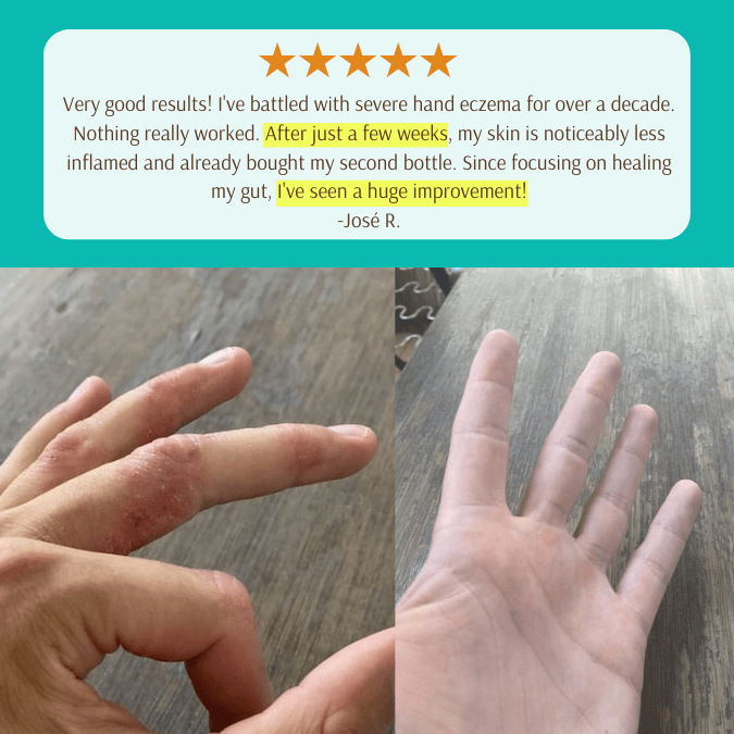 EczPro - Probiotics for Eczema, Natural Remedy, 13 Histamine-Safe Strains, Allergen-Free Formula