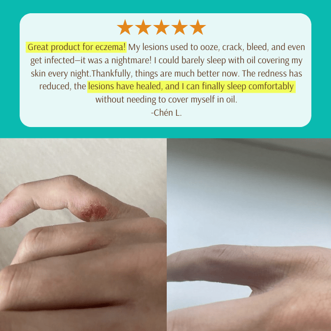 EczPro - Probiotics for Eczema, Natural Remedy, 13 Histamine-Safe Strains, Allergen-Free Formula