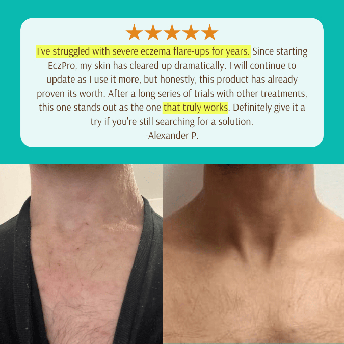 EczPro - Probiotics for Eczema, Natural Remedy, 13 Histamine-Safe Strains, Allergen-Free Formula