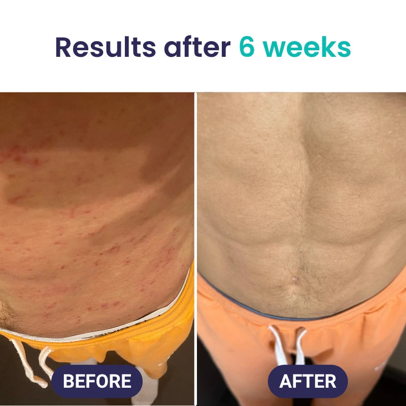 Kill Eczema at the Root Protocol