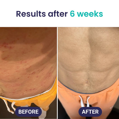 Kill Eczema at the Root Protocol
