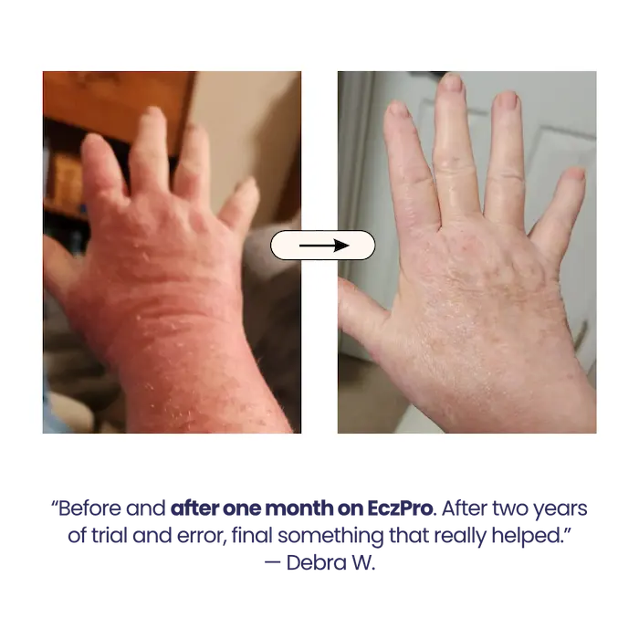 EczPro - Probiotics for Eczema, Natural Remedy, 13 Histamine-Safe Strains, Allergen-Free Formula