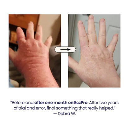 EczPro - Probiotics for Eczema, Natural Remedy, 13 Histamine-Safe Strains, Allergen-Free Formula