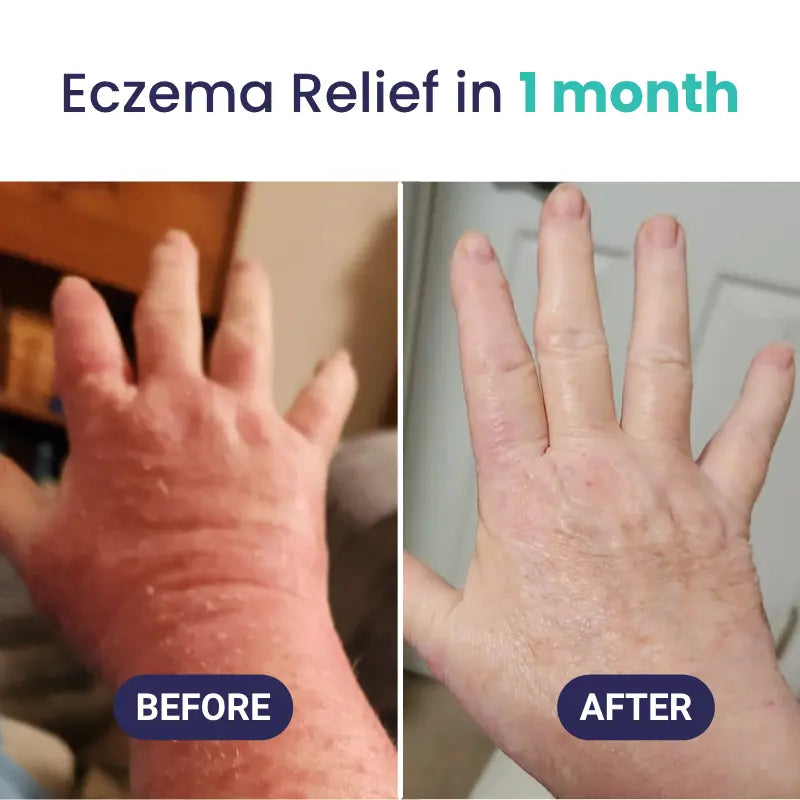 EczPro - Probiotics for Eczema, Natural Remedy, 13 Histamine-Safe Strains, Allergen-Free Formula