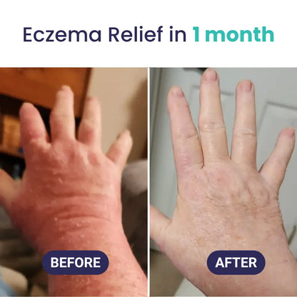 EczPro - Probiotics for Eczema, Natural Remedy, 13 Histamine-Safe Strains, Allergen-Free Formula