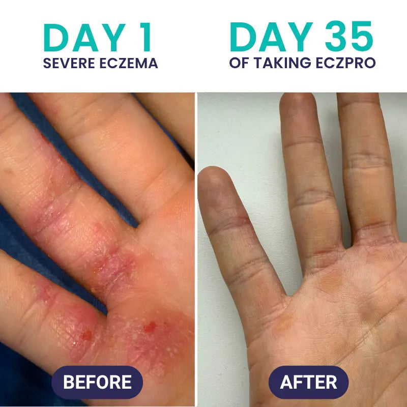 EczPro - Probiotics for Eczema, Natural Remedy, 13 Histamine-Safe Strains, Allergen-Free Formula