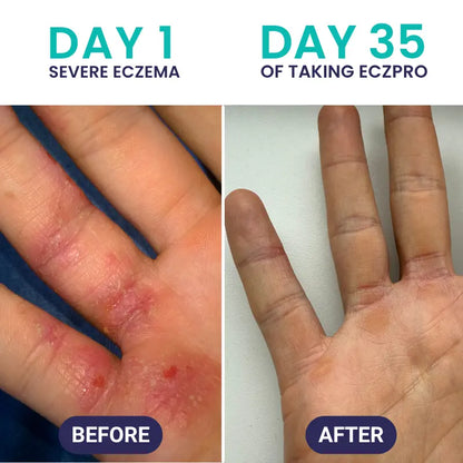 EczPro - Probiotics for Eczema, Natural Remedy, 13 Histamine-Safe Strains, Allergen-Free Formula